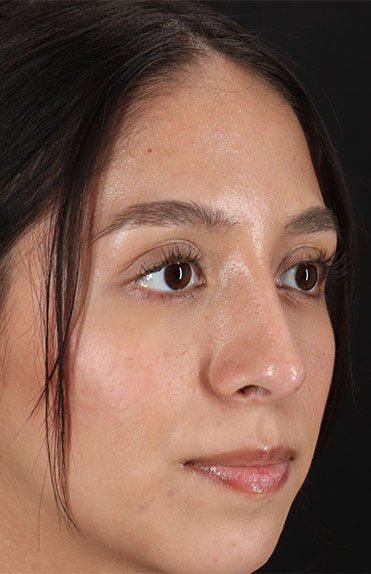 After - right_oblique