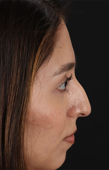 Before - right_lateral