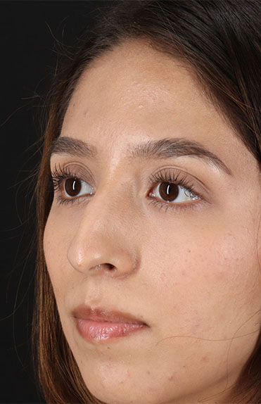 Before - left_oblique