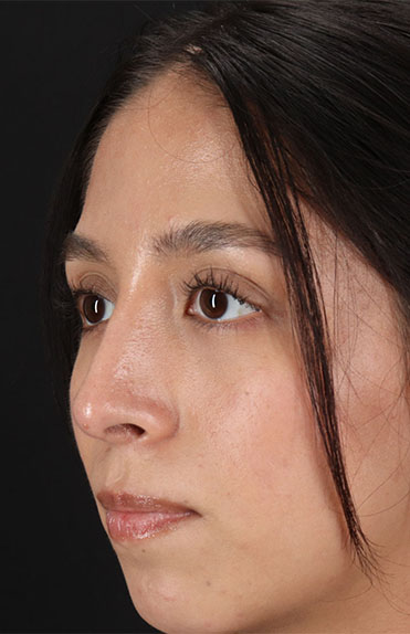 After - left_oblique