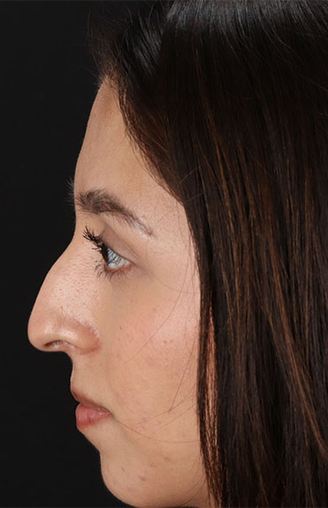 Before - left_lateral