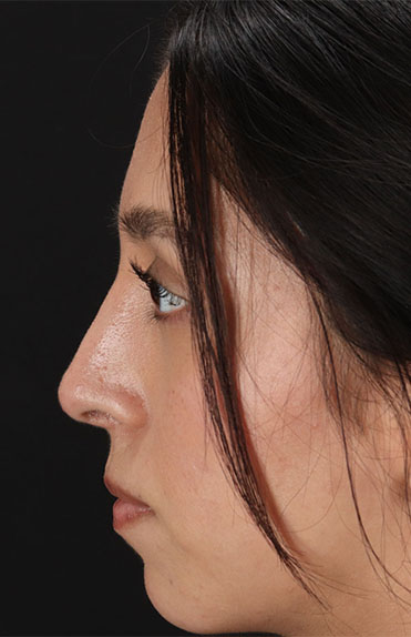 After - left_lateral