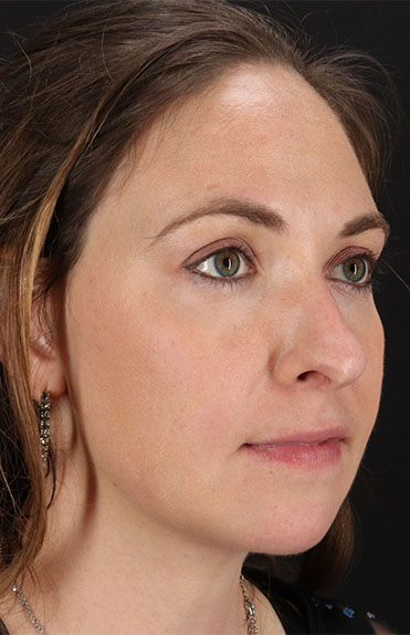 After - right_oblique