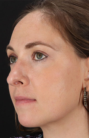 After - left_oblique