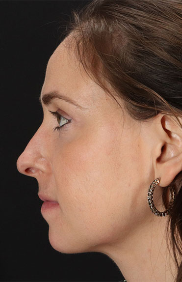 After - left_lateral