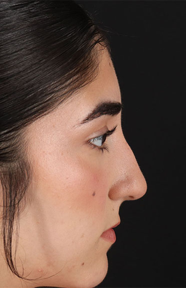 Before - right_lateral