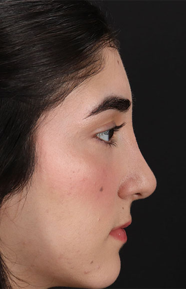 After - right_lateral