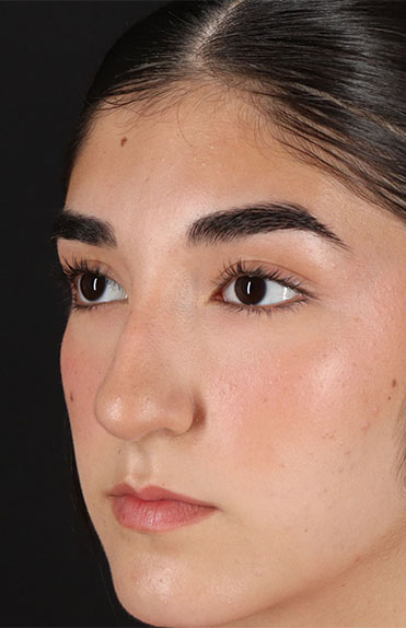 Before - left_oblique