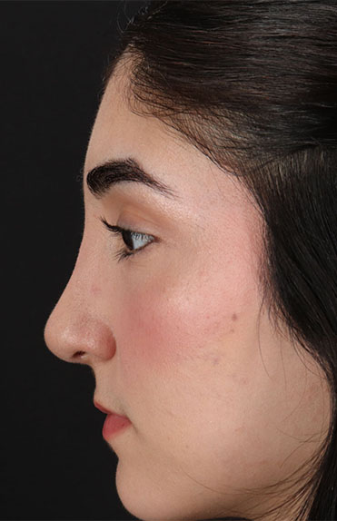 After - left_lateral