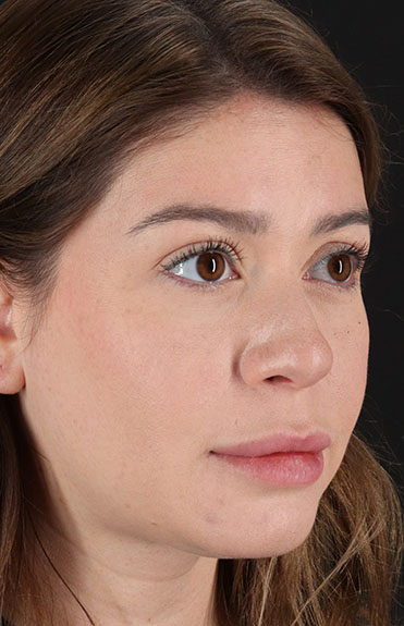 Before - right_oblique