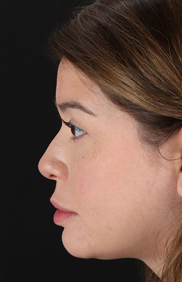 Before - left_lateral