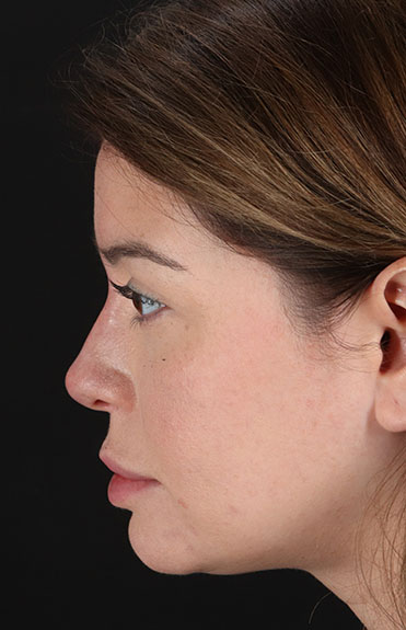 After - left_lateral