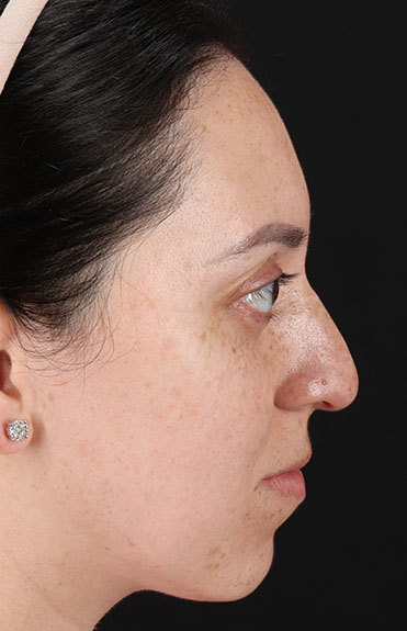 Before - right_lateral