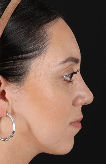 After - right_lateral