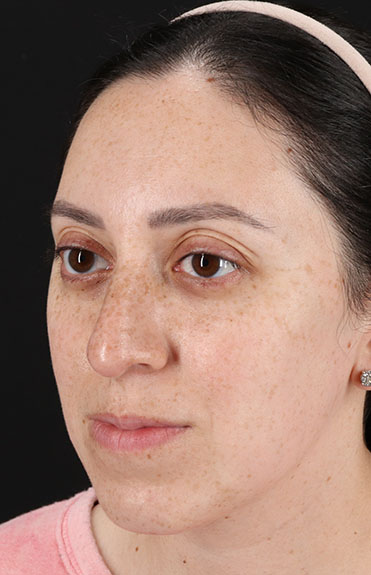 Before - left_oblique