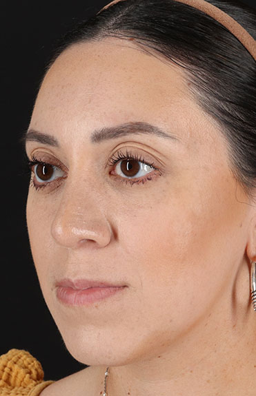 After - left_oblique