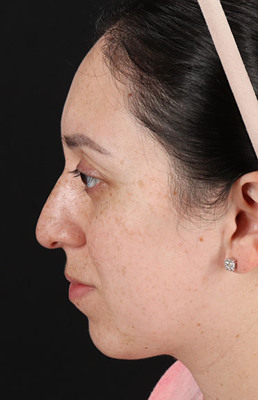 Before - left_lateral