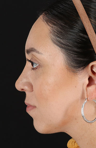 After - left_lateral