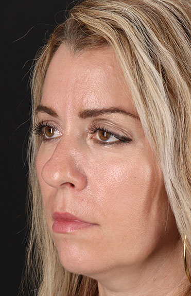 Before - left_oblique