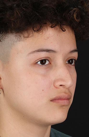 Before - right_oblique