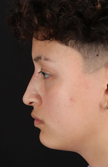 After - left_lateral