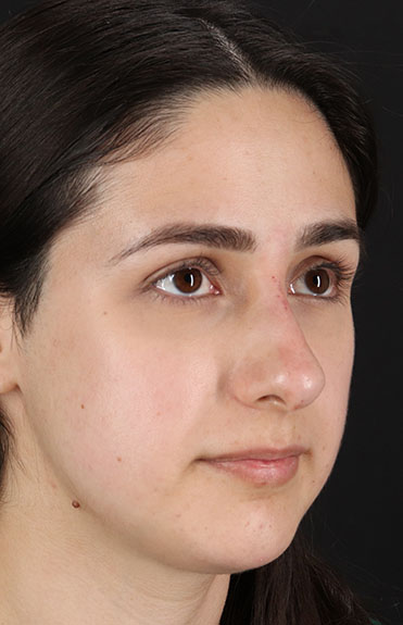 After - right_oblique