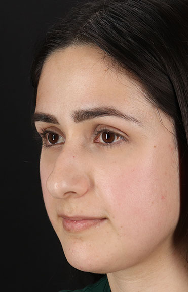 Before - left_oblique