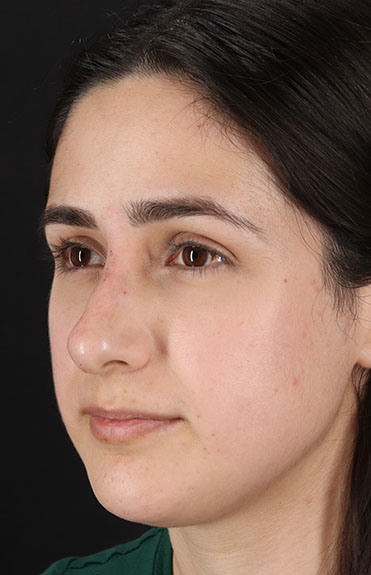 After - left_oblique