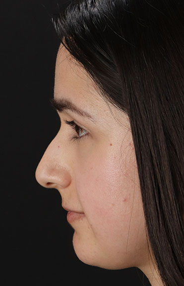 Before - left_lateral