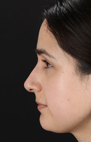 After - left_lateral