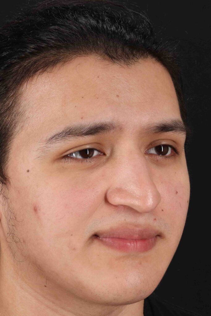 Before - right_oblique