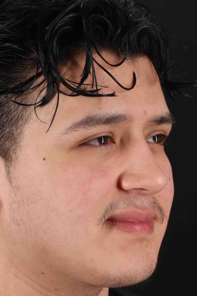 After - right_oblique