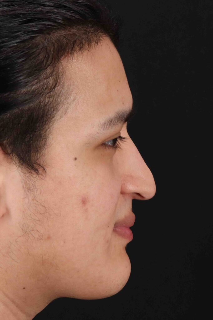 Before - right_lateral