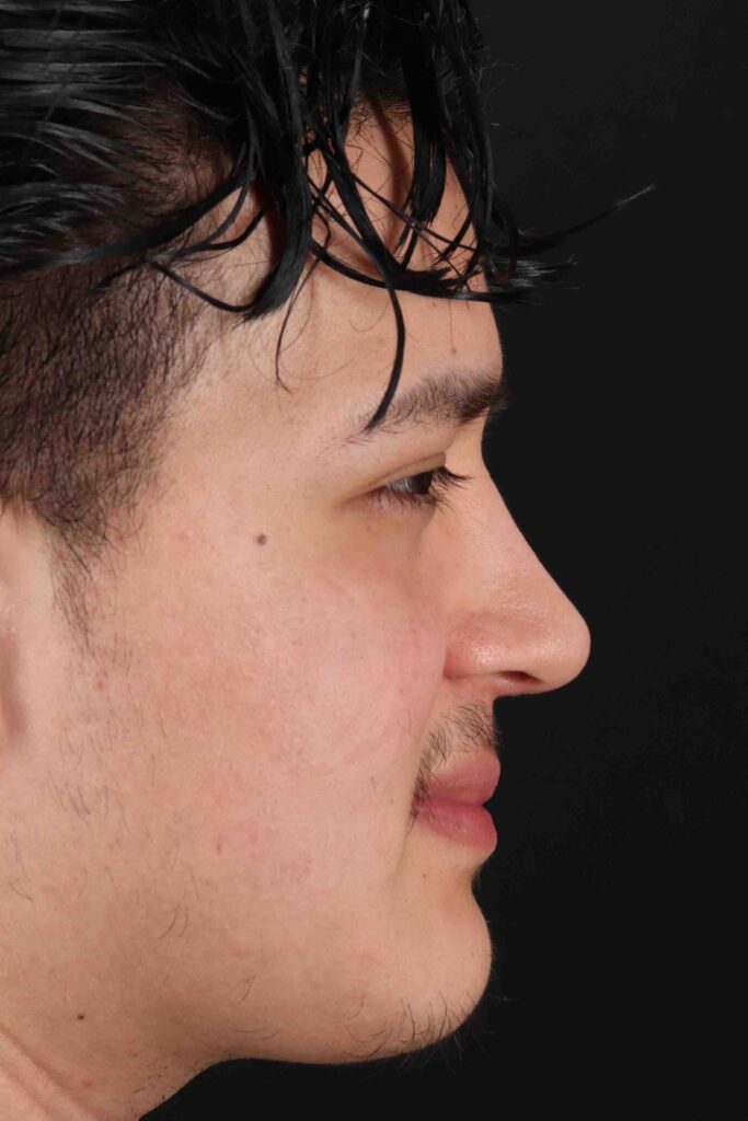 After - right_lateral