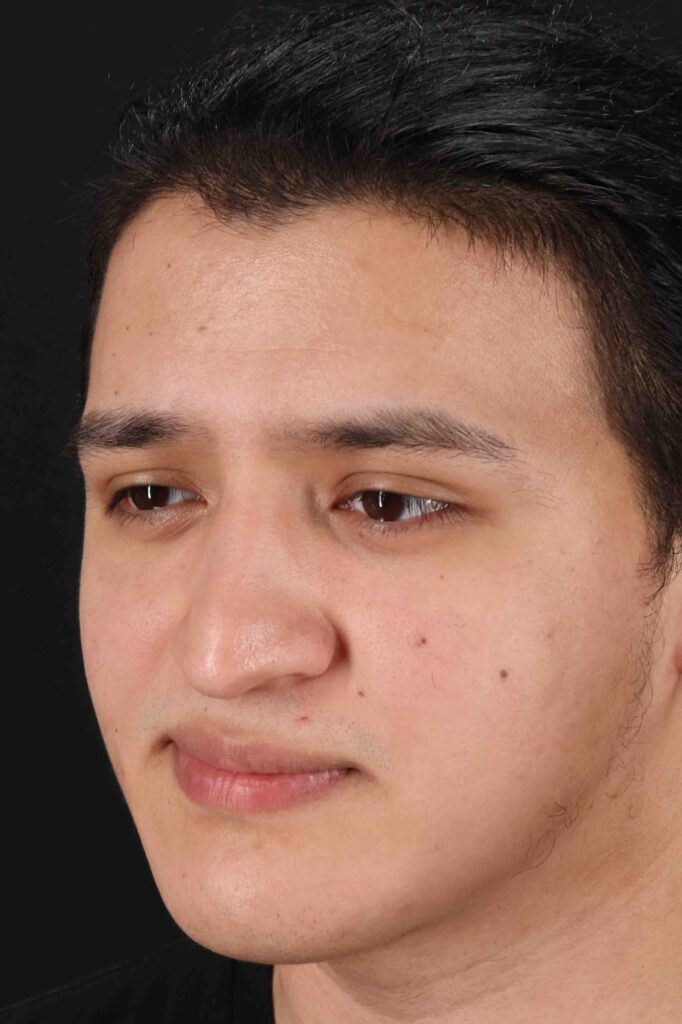 Before - left_oblique