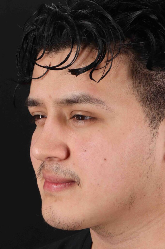 After - left_oblique