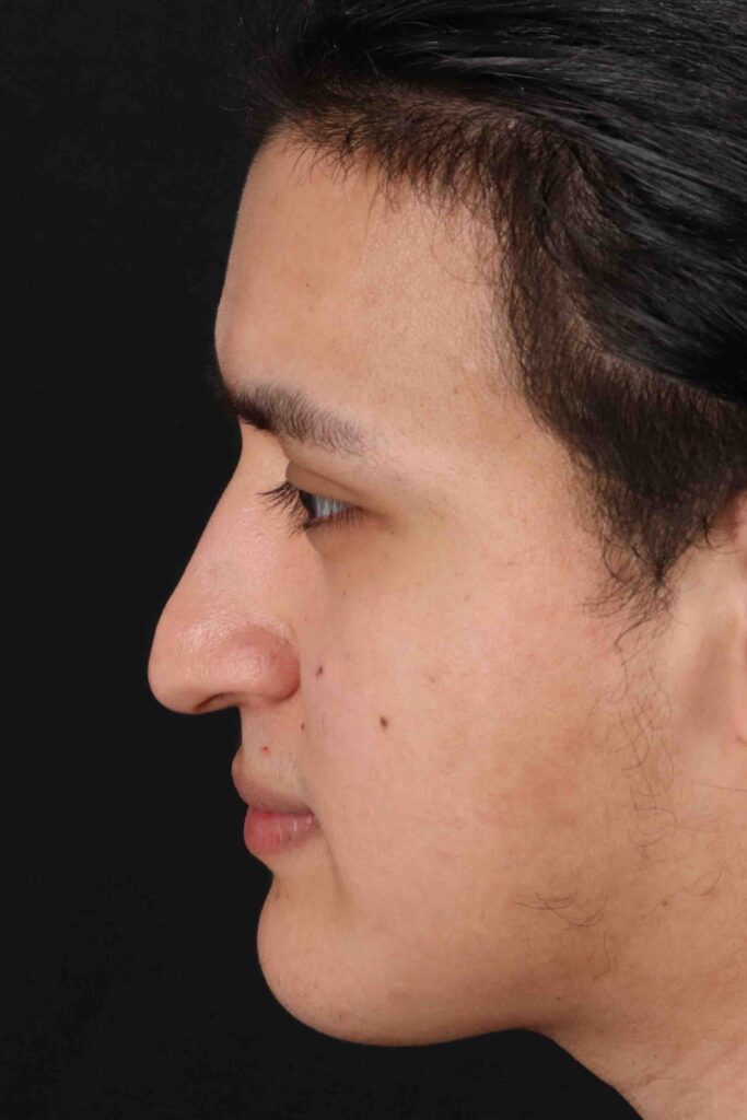 Before - left_lateral