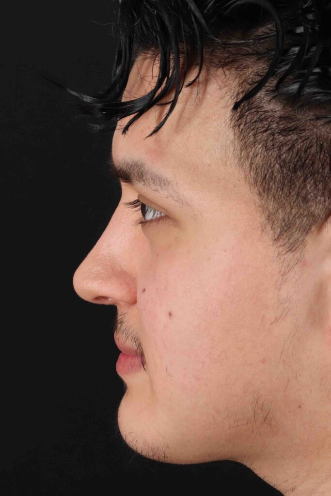 After - left_lateral