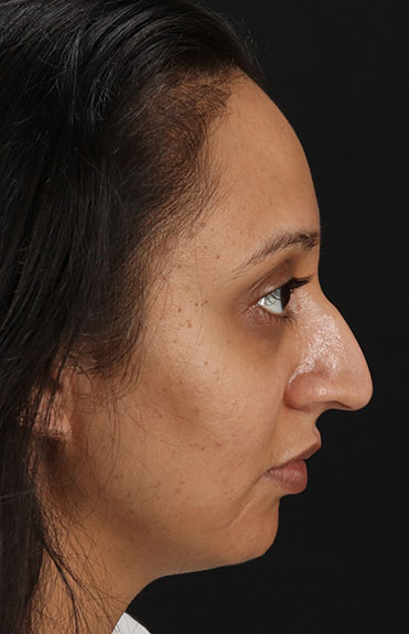 Before - right_lateral