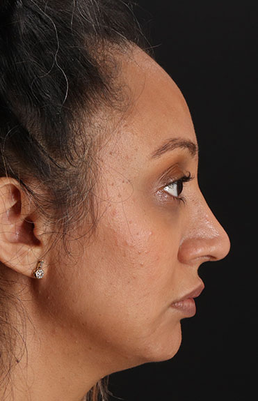 After - right_lateral