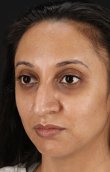 Before - left_oblique