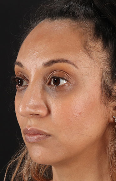 After - left_oblique