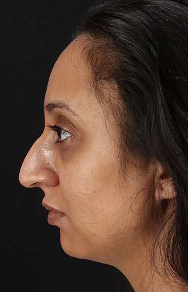 Before - left_lateral