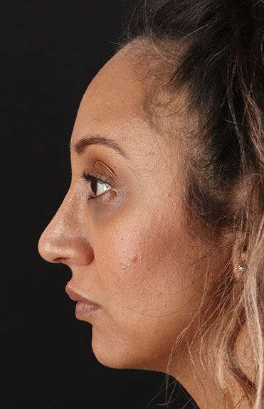 After - left_lateral