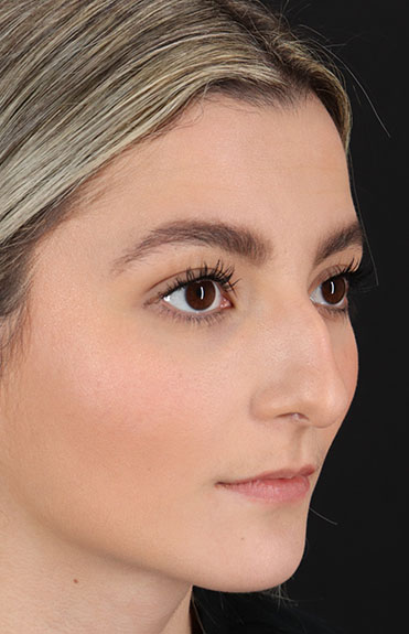 Before - right_oblique