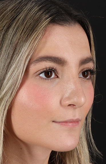 After - right_oblique