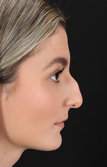 Before - right_lateral