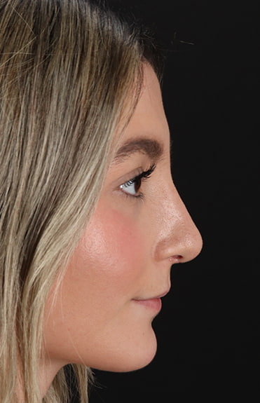 After - right_lateral