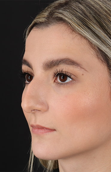 Before - left_oblique