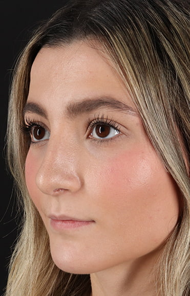 After - left_oblique